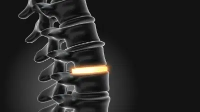 Artificial Disc Replacement